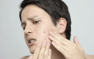 How to Minimise Scarring During Acne Breakouts